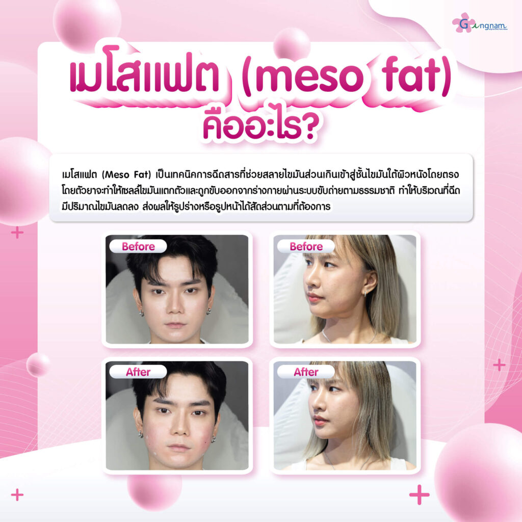 เมโสแฟต คือ