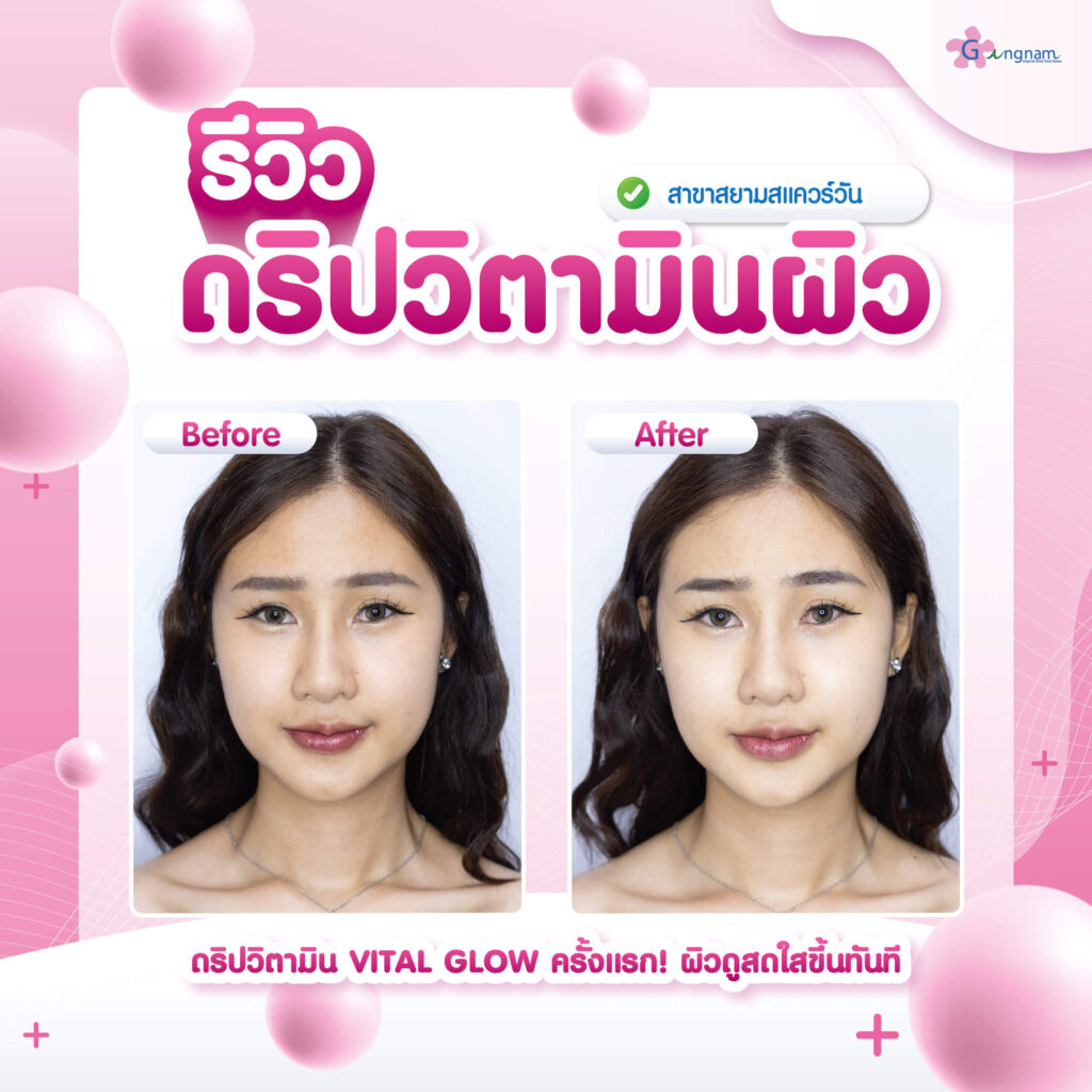 รีวิว ดริปวิตามินผิว ผู้หญิง