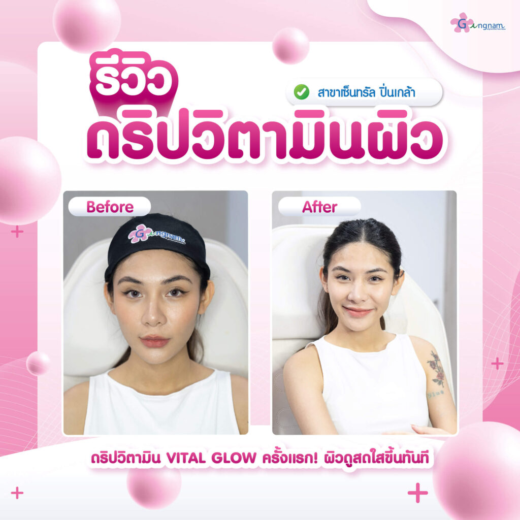 รีวิวดริปวิตามินผิว