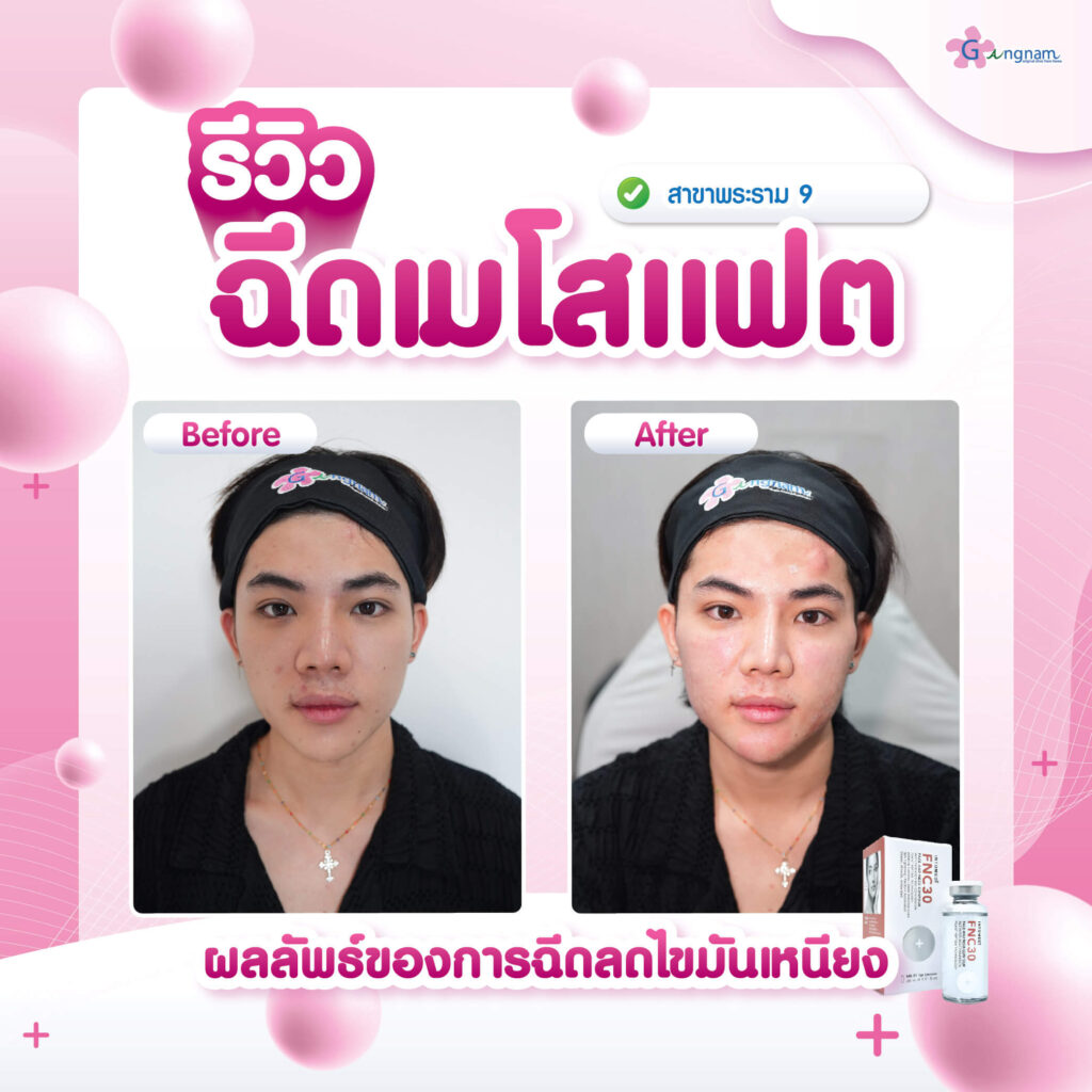 รีวิวฉีดเมโสแฟต
