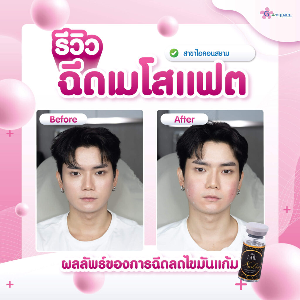 รีวิวฉีดเมโสแฟต