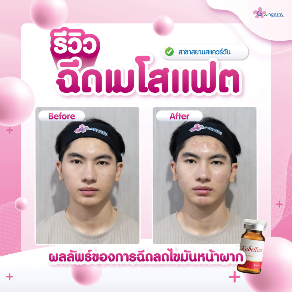 รีวิวฉีดเมโสแฟต