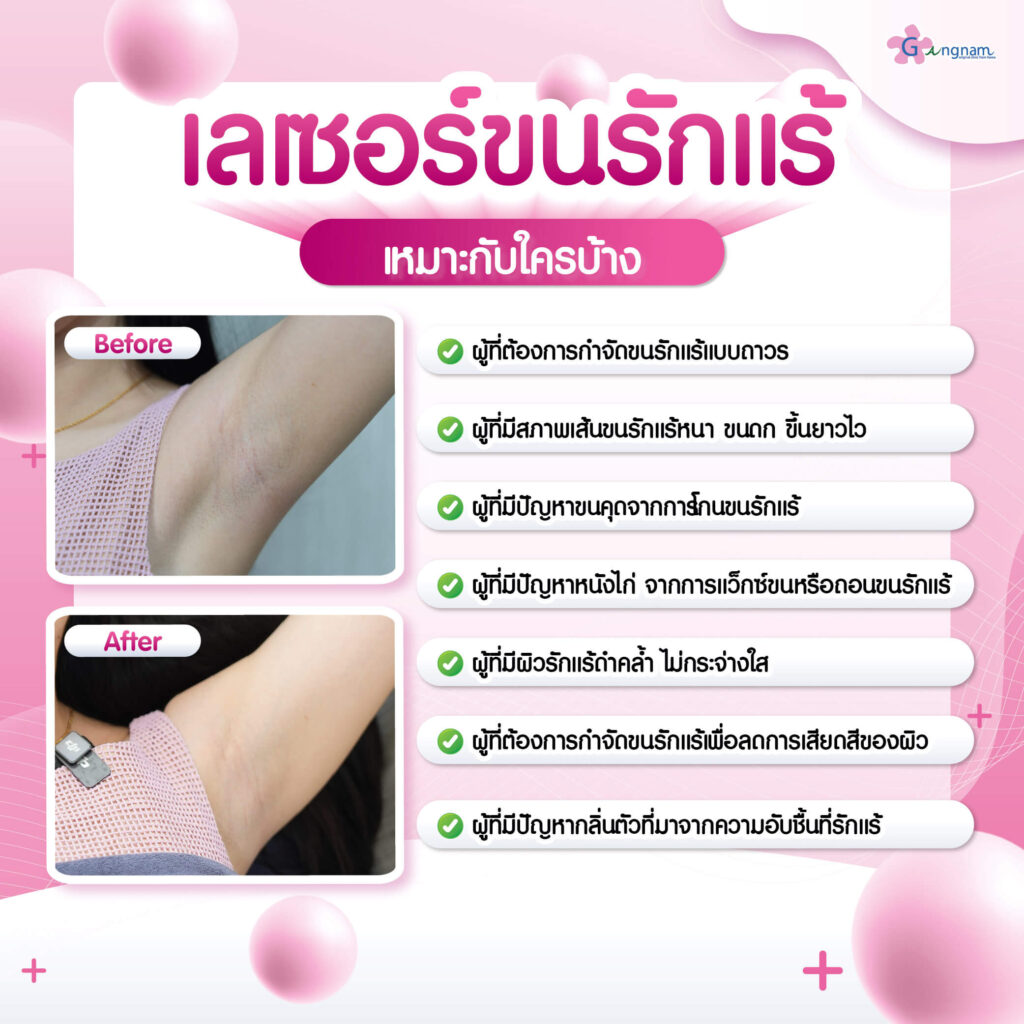 ผู้ที่ควรทำเลเซอร์ขนรักแร้