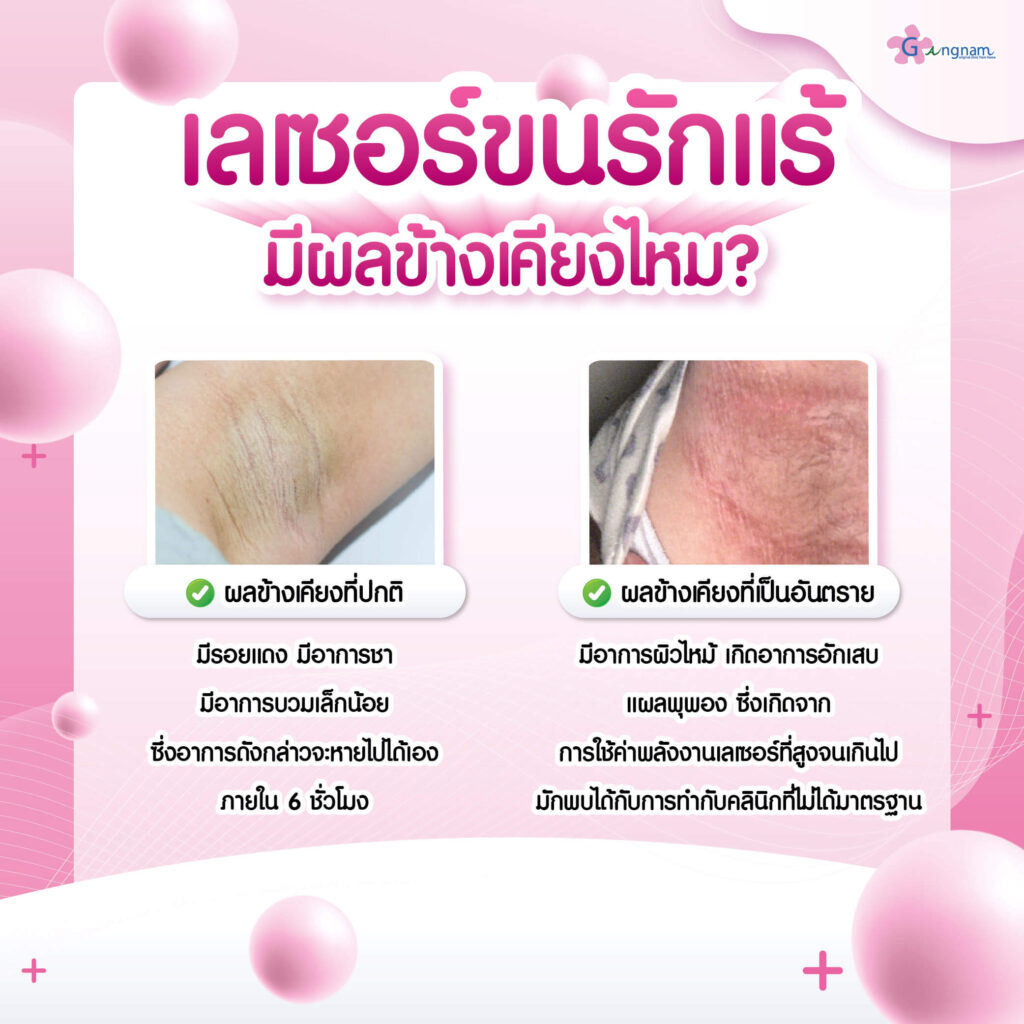 ผลข้างเคียงของการทำเลเซอร์รักแร้