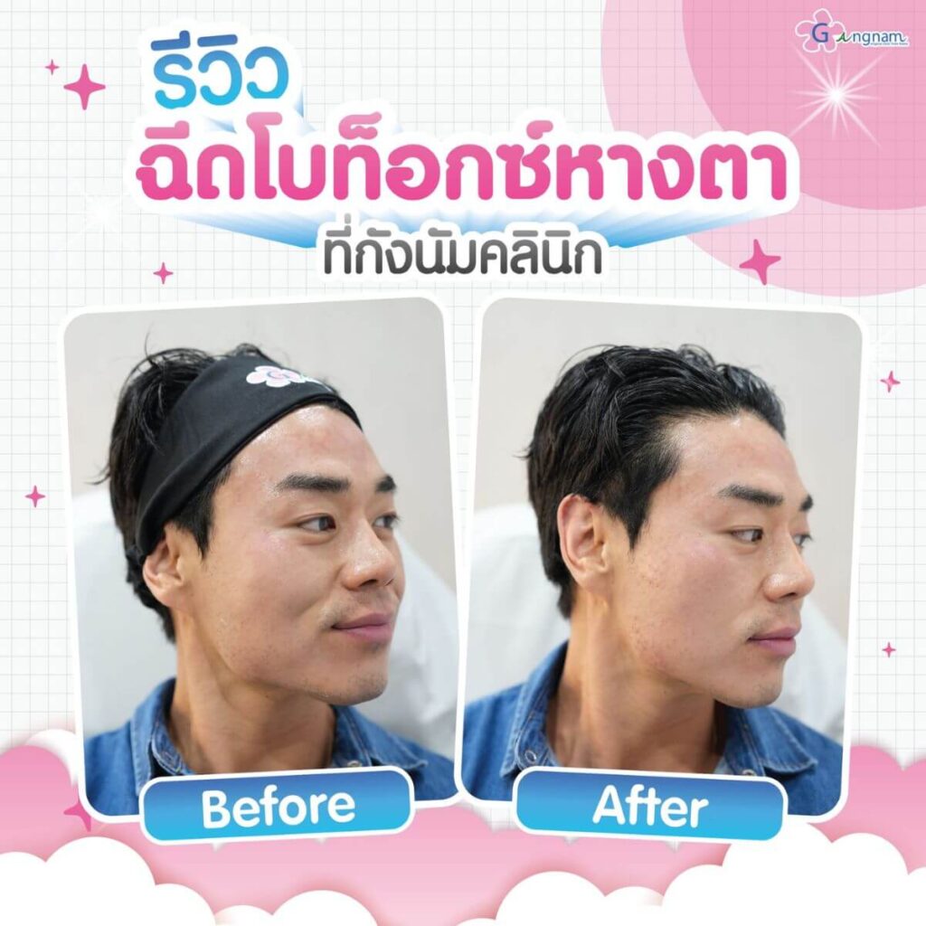ฉีดโบท็อกซ์หางตา ที่กังนัมคลินิก