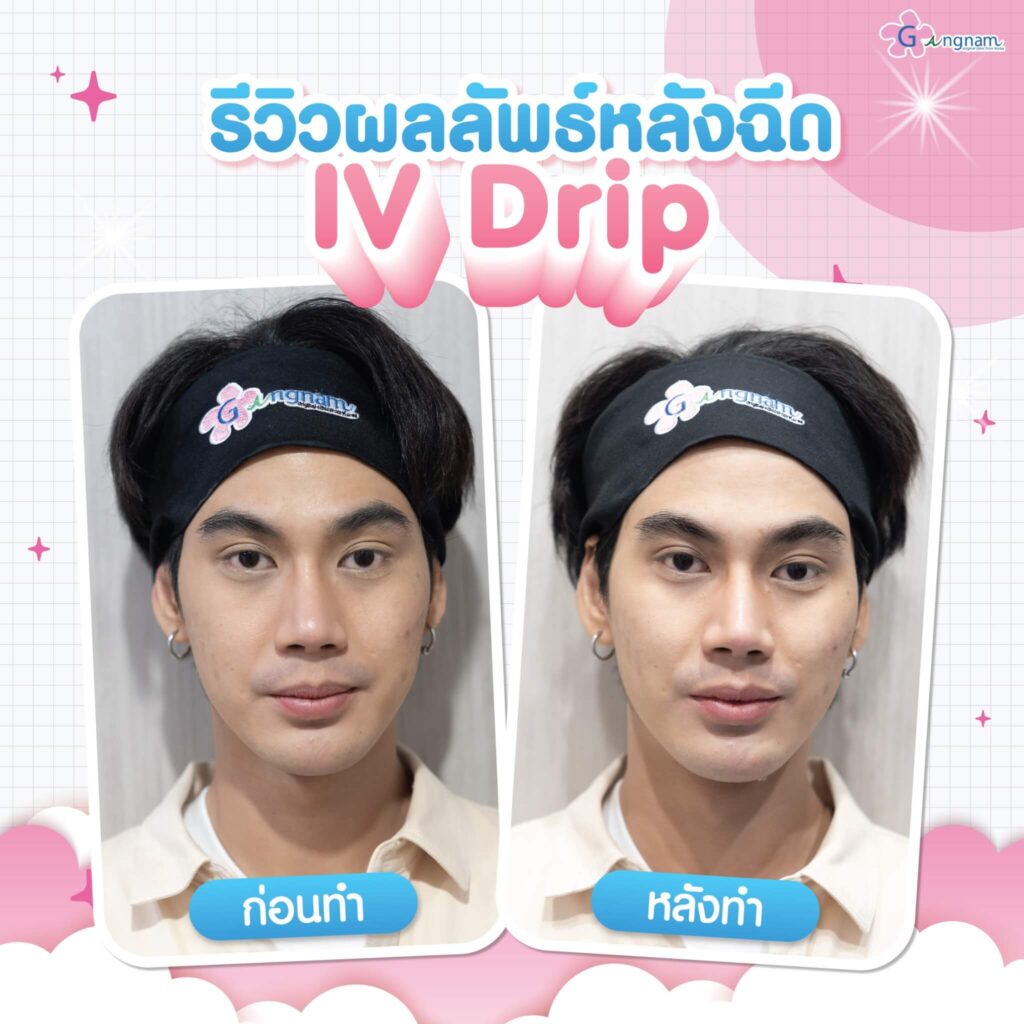 รีวิว ฉีดผิว IV Drip กังนัมคลินิก
