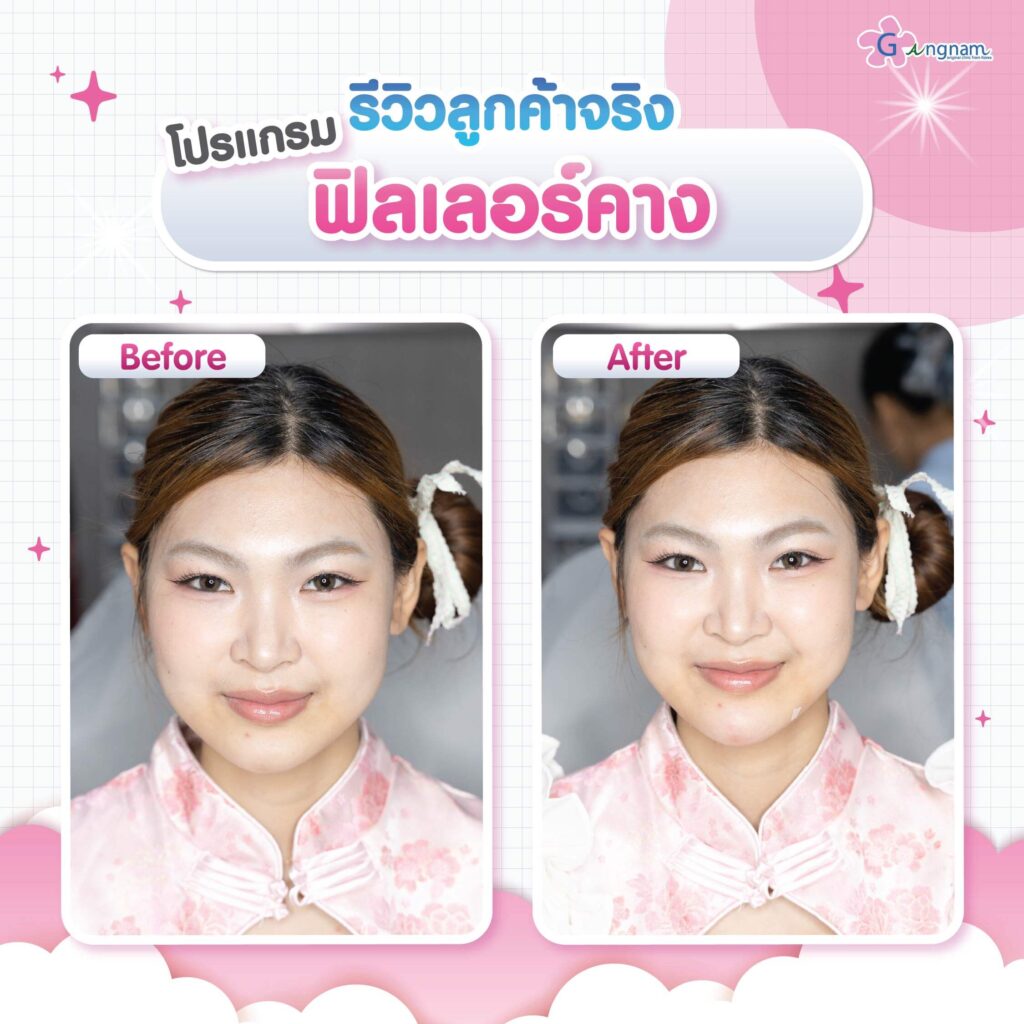 รีวิว ฉีดฟิลเลอร์คาง Gangnam Clinic