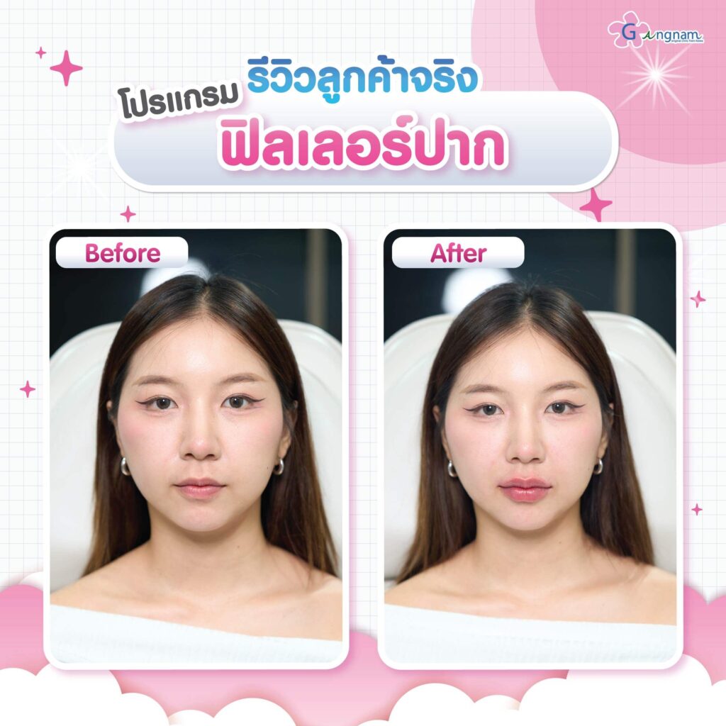 รีวิว ฉีดฟิลเลอร์ปรับรูปทรงปาก Gangnam Clinic