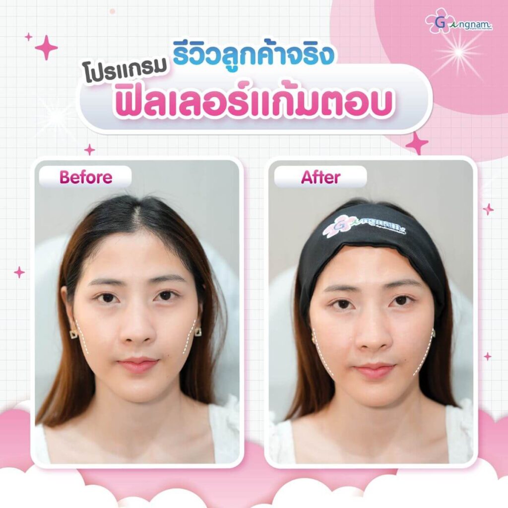 รีวิว ฉีดฟิลเลอร์แก้มตอบ gangnam clinic