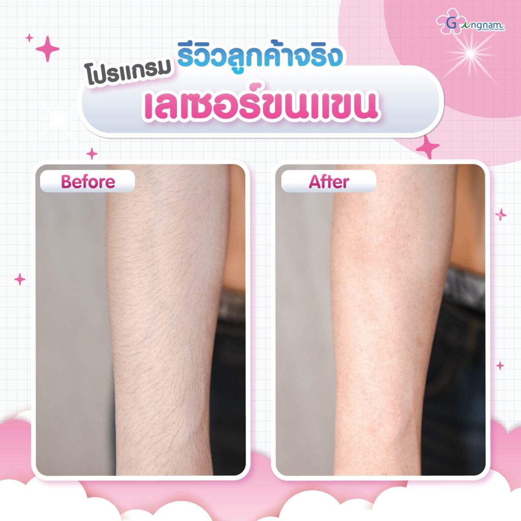 รีวิว เลเซอร์ขนแขน กังนัมคลินิก