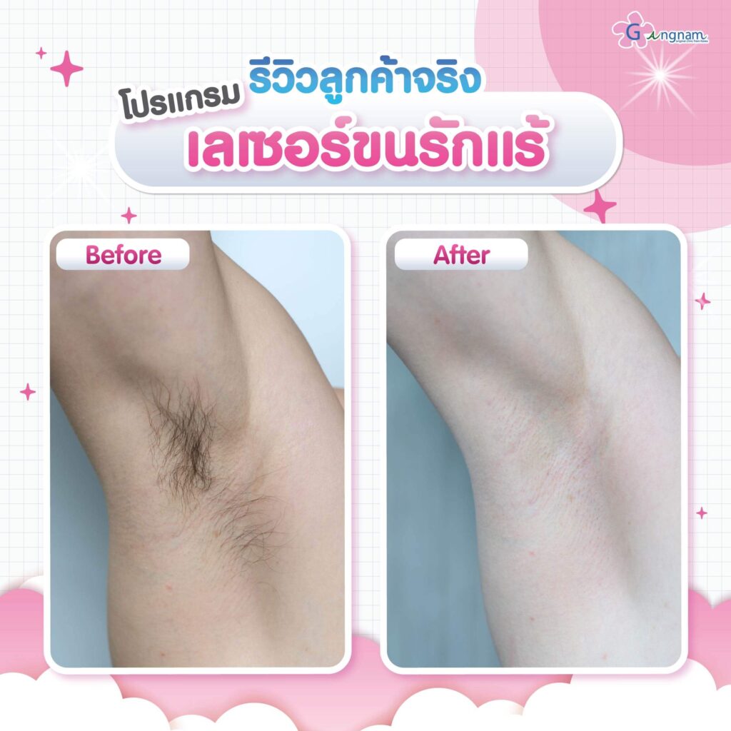 รีวิว เลเซอร์ขนรักแร้ กังนัมคลินิก