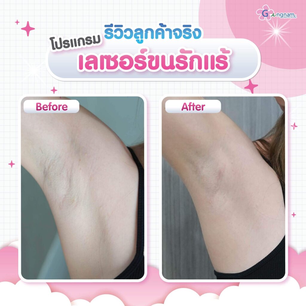 รีวิว เลเซอร์ขนรักแร้ กังนัมคลินิก