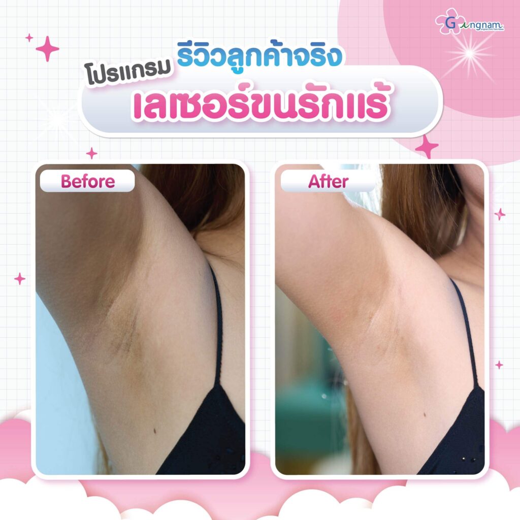 รีวิว เลเซอร์ขนรักแร้ กังนัมคลินิก