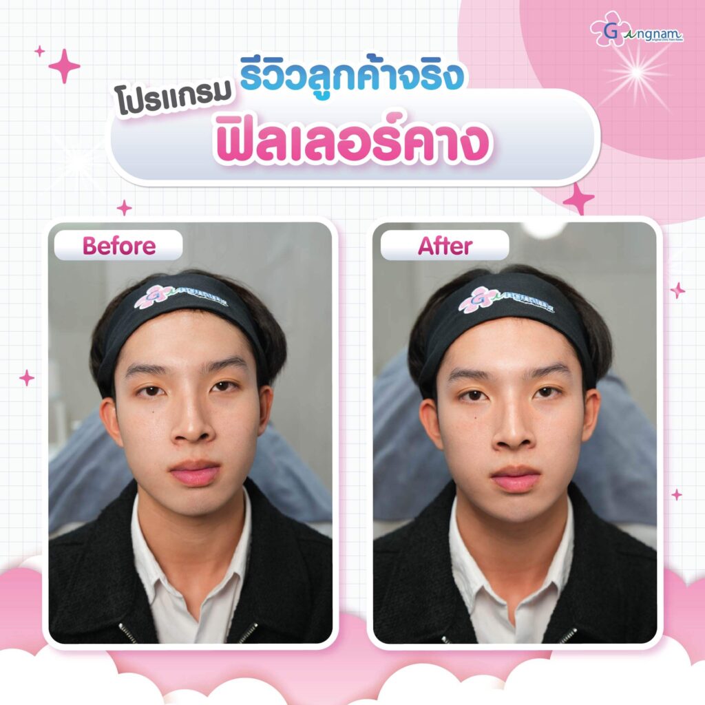 รีวิวฉีดฟิลเลอร์คาง ปรับรูปทรงใบหน้า