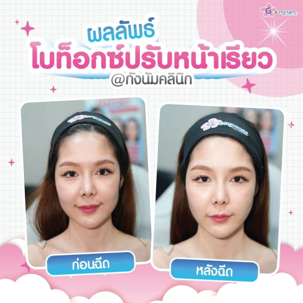 โบท็อกซ์ปรับรูปหน้าเรียว กังนัมคลินิก