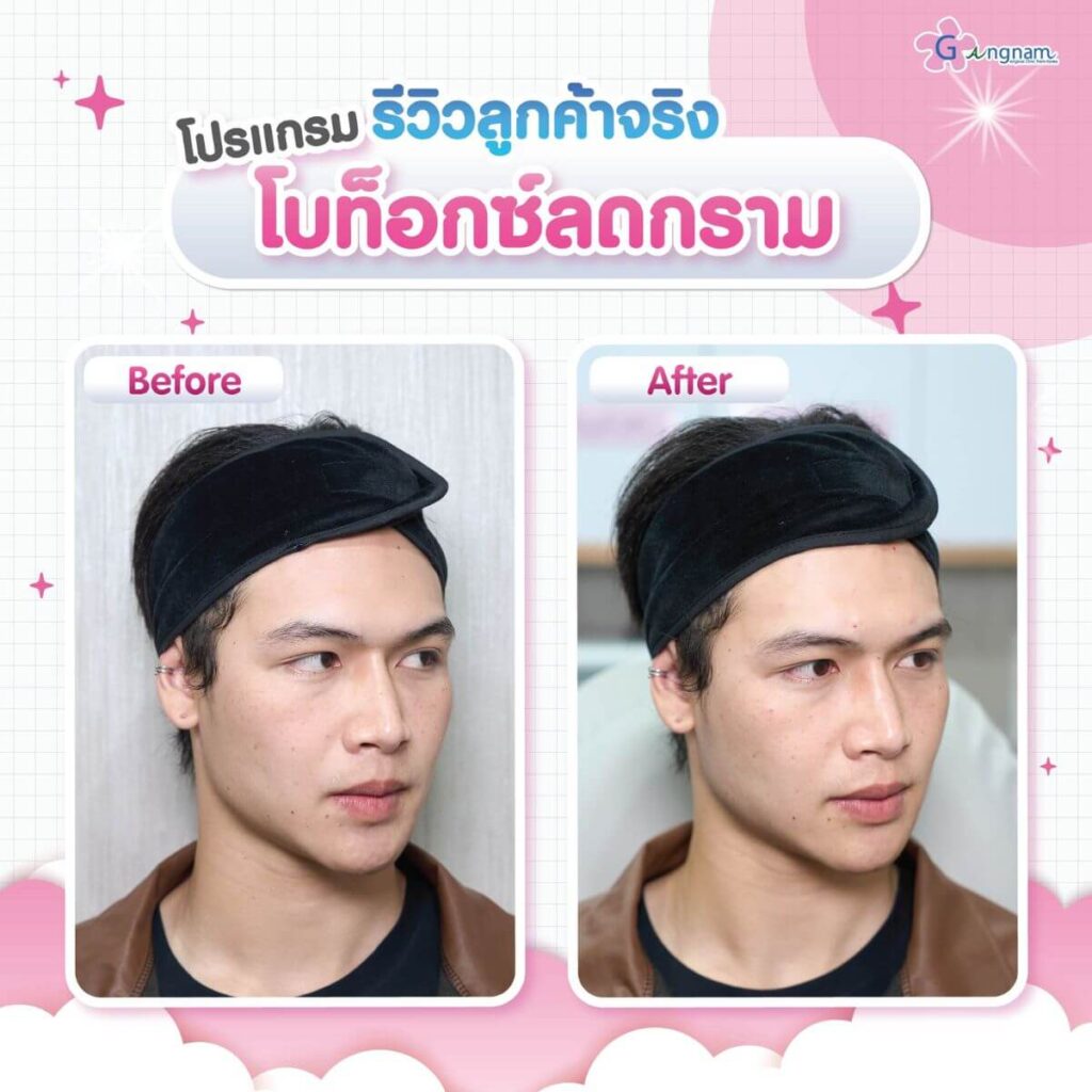 โบท็อกซ์ลดกราม กังนัมคลินิก
